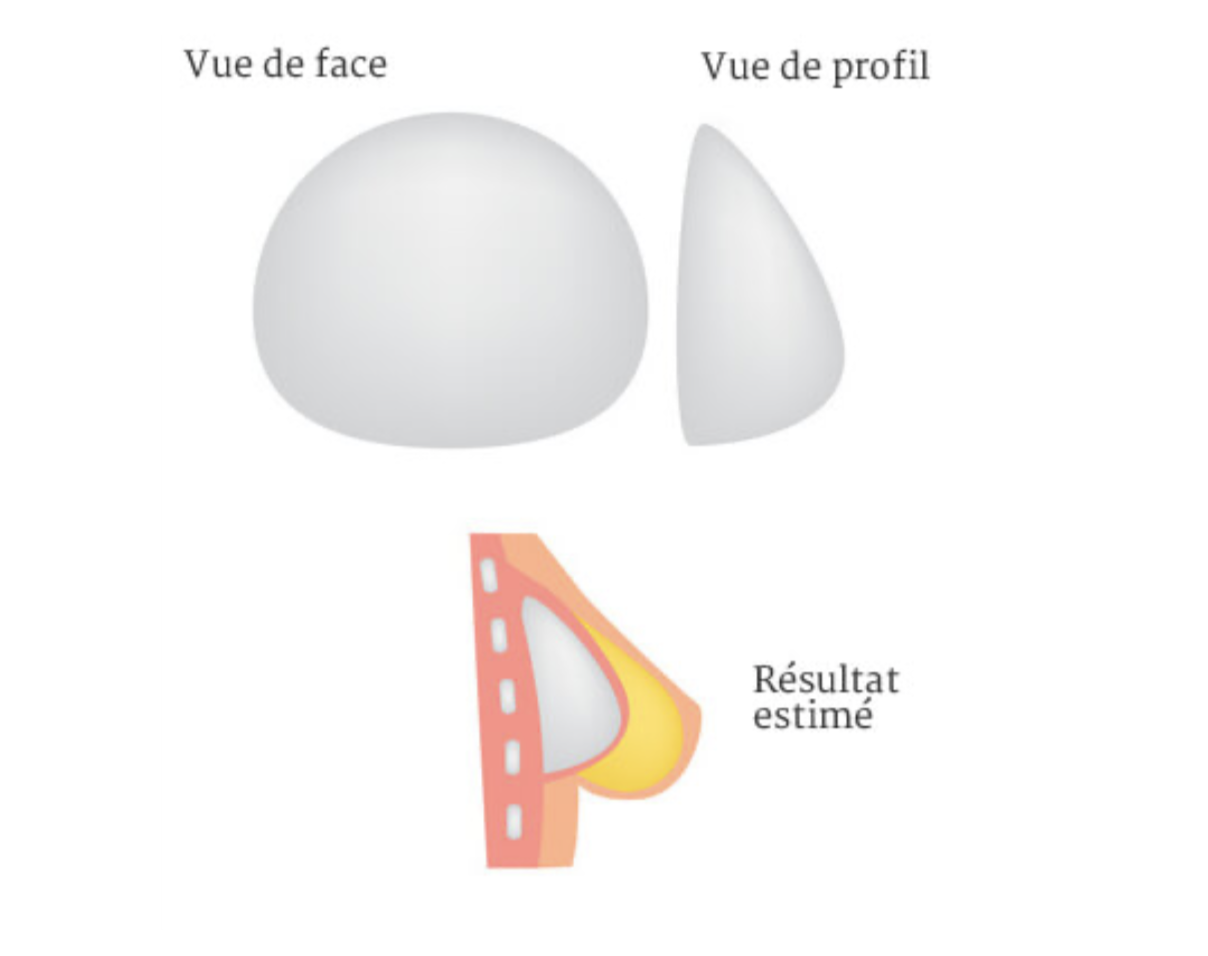 Quels Implants Mammaires Choisir Taille Forme Nos Conseils